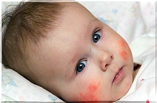 baby with atopic dermatitis